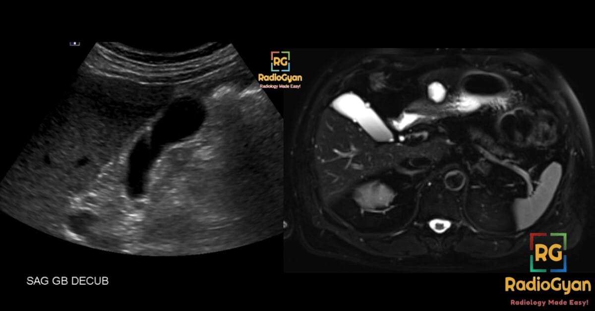 Ultrasound and MRI images of the gallbladder showing adenomyomatosis pathology and Rokitansky-Aschoff sinuses.