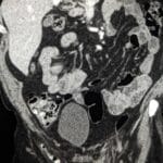CT image showing an Amyand hernia with appendix within an inguinal hernia sac.