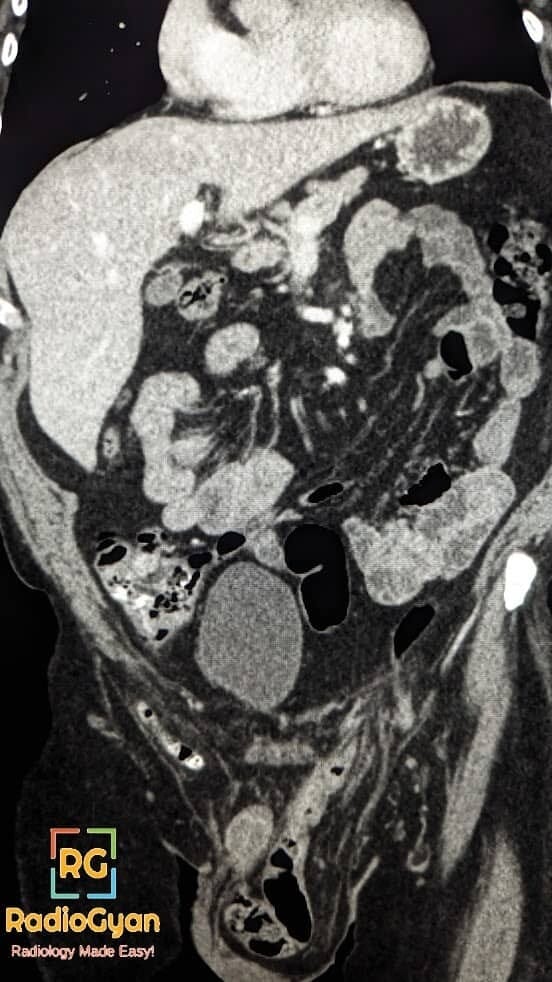 CT image showing an Amyand hernia with appendix within an inguinal hernia sac.