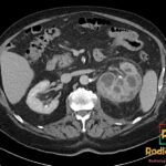 Axial CT scan of the abdomen showing a left kidney with xanthogranulomatous pyelonephritis, characteristic 'bear paw' sign.