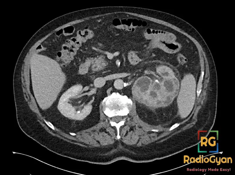 Axial CT scan of the abdomen showing a left kidney with xanthogranulomatous pyelonephritis, characteristic 'bear paw' sign.