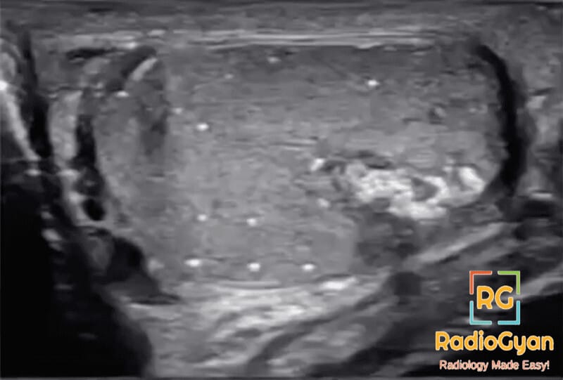 Ultrasound image of a testis showing features of burnt-out testicular seminoma, including calcifications and scarring.