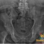 Pelvic X-ray showing bilateral calcified vas deferens, a classic sign of long-standing diabetes mellitus.