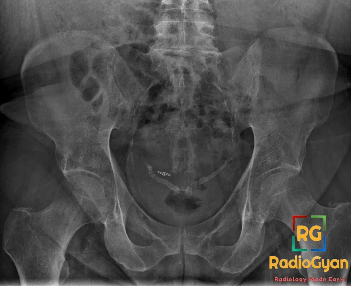 Pelvic X-ray showing bilateral calcified vas deferens, a classic sign of long-standing diabetes mellitus.