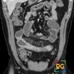 Coronal CT image of the abdomen showing the 'comb sign' indicative of Crohn's disease in the small bowel.