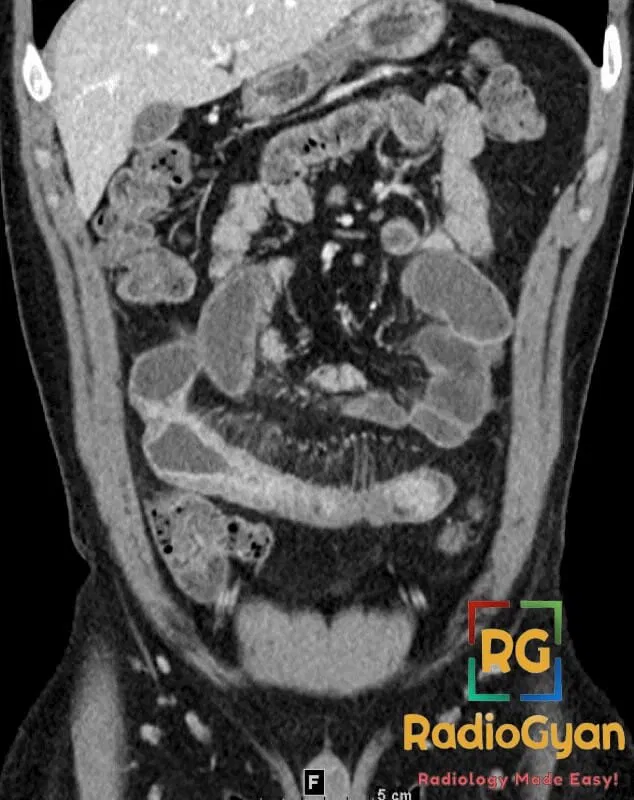 Coronal CT image of the abdomen showing the 'comb sign' indicative of Crohn's disease in the small bowel.