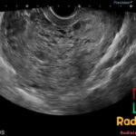 Ultrasound image of a uterus demonstrating a complete molar pregnancy with characteristic hyperplastic chorionic villi.