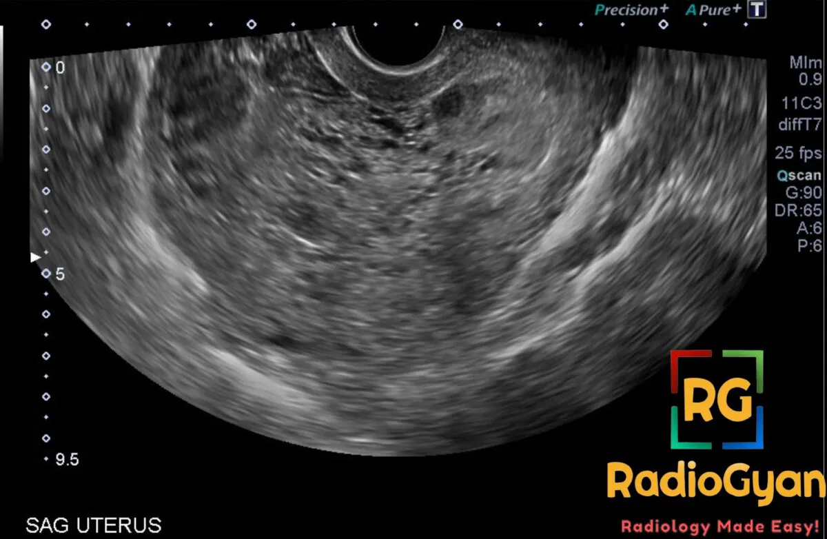 Ultrasound image of a uterus demonstrating a complete molar pregnancy with characteristic hyperplastic chorionic villi.