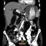 CT abdomen coronal view showing dilated common bile duct and pancreatic duct, indicative of double duct sign.