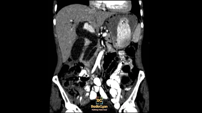 CT abdomen coronal view showing dilated common bile duct and pancreatic duct, indicative of double duct sign.