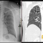 Chest X-ray and CT scans showing finger-in-glove appearance in lungs due to allergic bronchopulmonary aspergillosis.