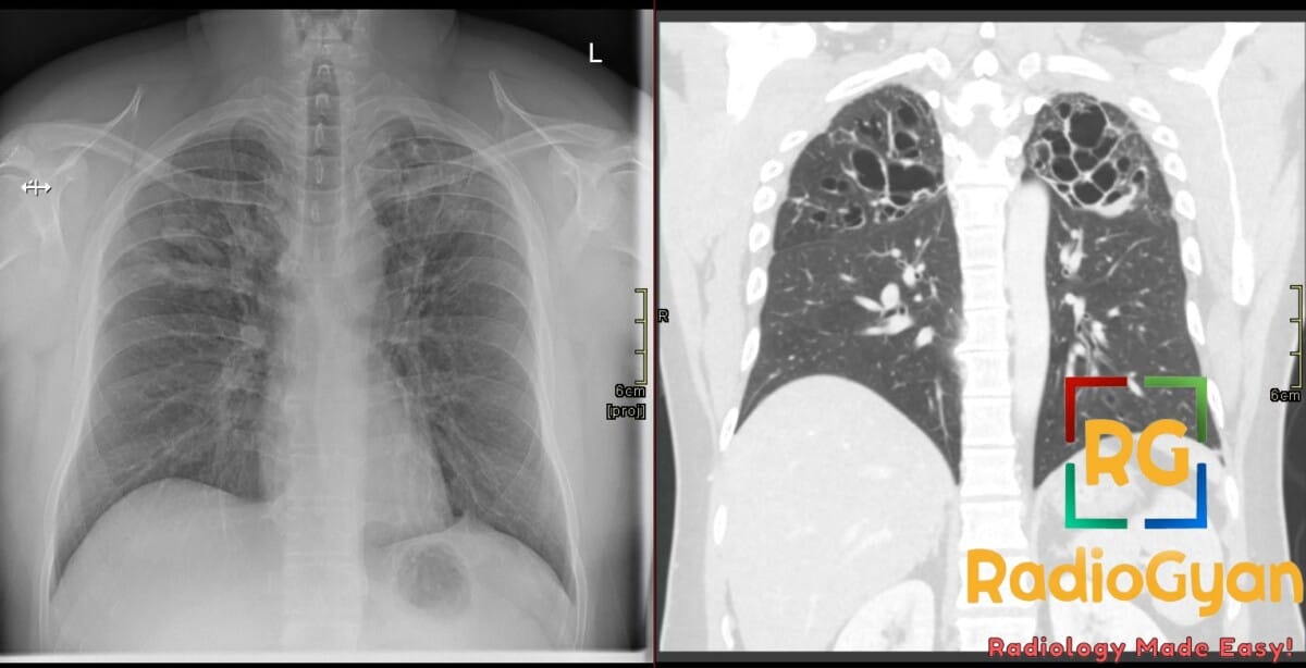 Chest X-ray and CT scans showing finger-in-glove appearance in lungs due to allergic bronchopulmonary aspergillosis.