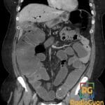 Coronal CT abdomen showing small bowel obstruction and a large gallstone in the ileum