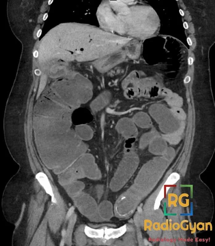 Coronal CT abdomen showing small bowel obstruction and a large gallstone in the ileum
