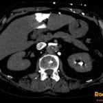 Axial CT scan of the liver showing a 'hot quadrate sign' due to superior vena cava obstruction. Hyperenhancing quadrate lobe.