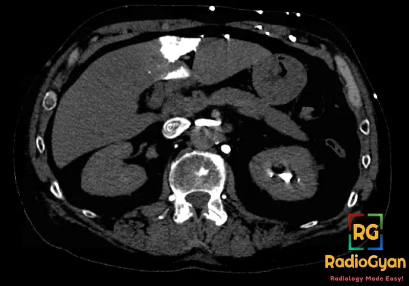 Axial CT scan of the liver showing a 'hot quadrate sign' due to superior vena cava obstruction. Hyperenhancing quadrate lobe.