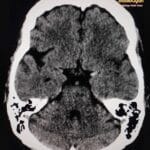 Axial CT brain revealing a hyperdense right middle cerebral artery (MCA) sign, indicative of acute ischemic stroke.