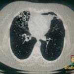 CT thorax showing bronchiectasis, nodular opacities, and cavitation in the right lung, characteristic of Lady Windermere syndrome.