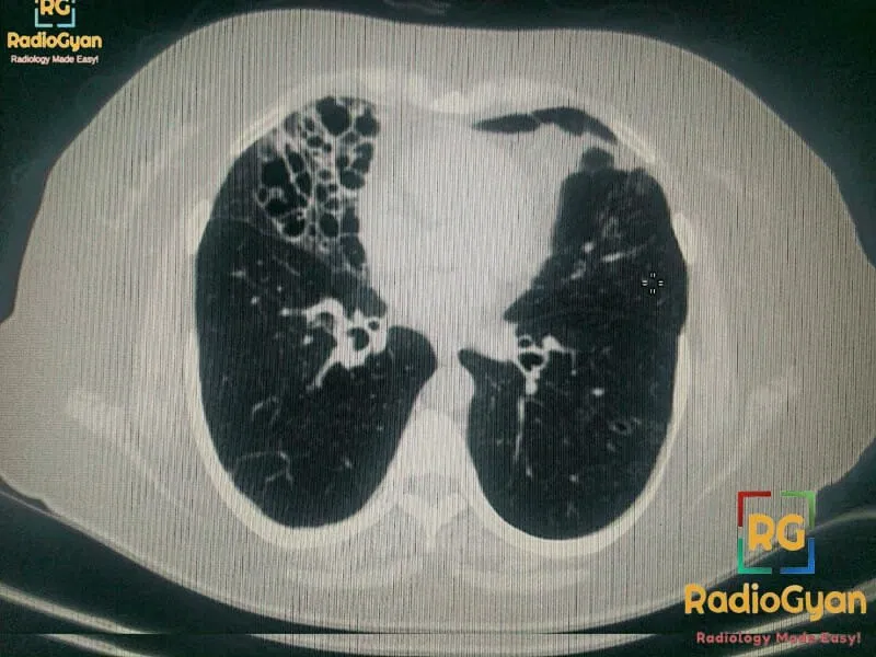 CT thorax showing bronchiectasis, nodular opacities, and cavitation in the right lung, characteristic of Lady Windermere syndrome.