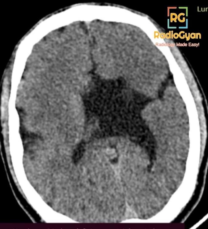 CT brain scan showing left-open-lip schizencephaly, characterized by a cerebrospinal fluid-filled cleft extending to the pial surface.