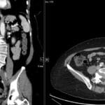 CT scan of the abdomen and pelvis showing May-Thurner Syndrome, with left common iliac vein compression.