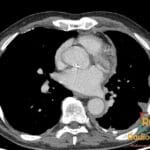 Axial CT chest image showing diffuse pleural thickening and calcifications suggestive of mesothelioma.