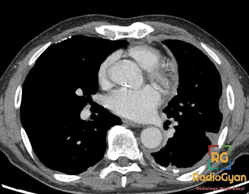 Axial CT chest image showing diffuse pleural thickening and calcifications suggestive of mesothelioma.