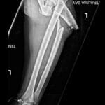 Left arm X-ray displaying Monteggia fracture-dislocation: ulna fracture with radial head dislocation.
