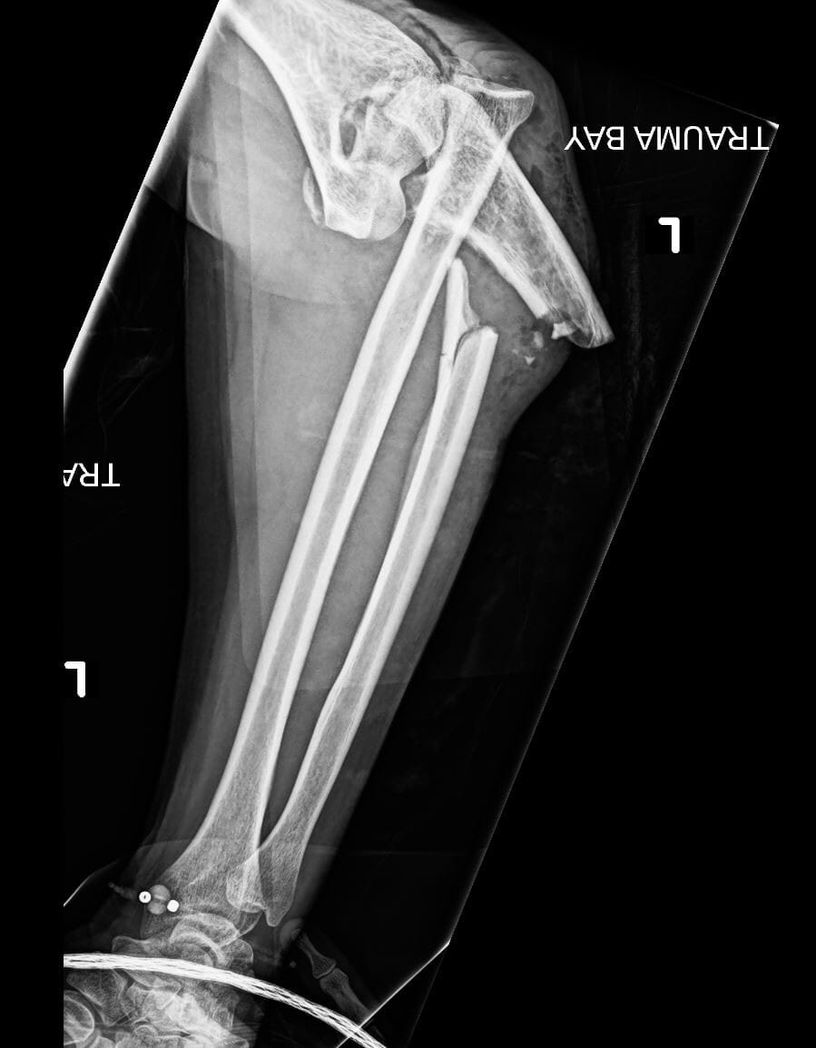 Left arm X-ray displaying Monteggia fracture-dislocation: ulna fracture with radial head dislocation.