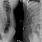 Abdominal X-rays showing significant bowel dilatation on the left, resolved on the right two days later.