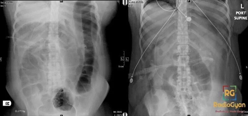 Abdominal X-rays showing significant bowel dilatation on the left, resolved on the right two days later.