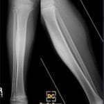 AP and lateral X-ray views of a tibia showing an osteoid osteoma with cortical thickening.