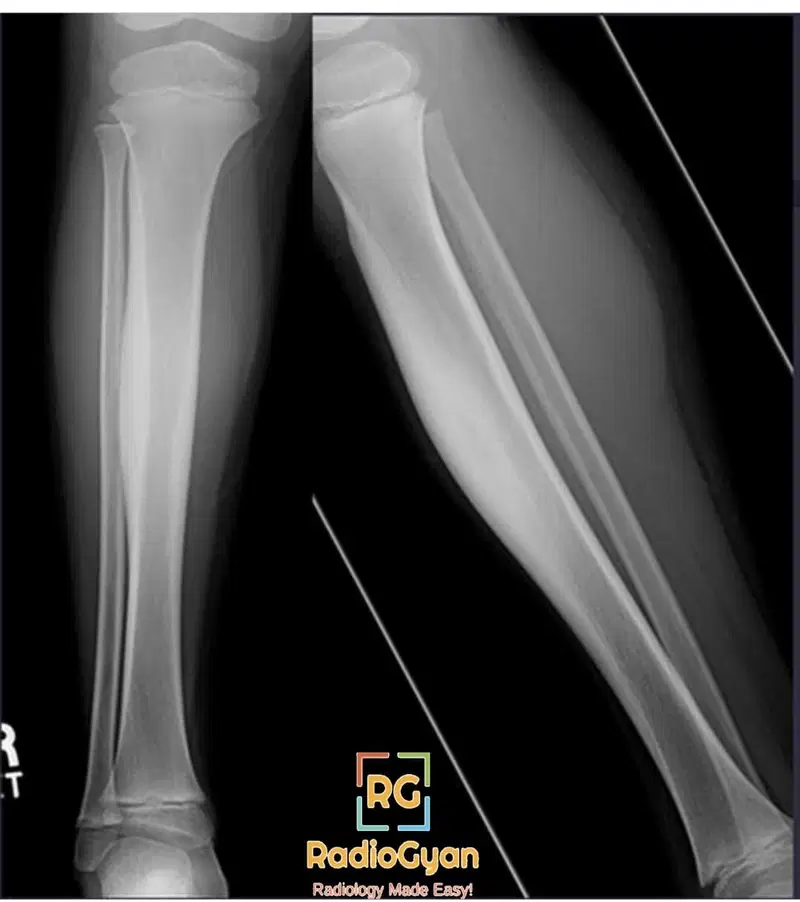 AP and lateral X-ray views of a tibia showing an osteoid osteoma with cortical thickening.