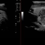 Ultrasound image of the right thyroid lobe showing a suspicious nodule with microcalcifications, consistent with papillary thyroid cancer.