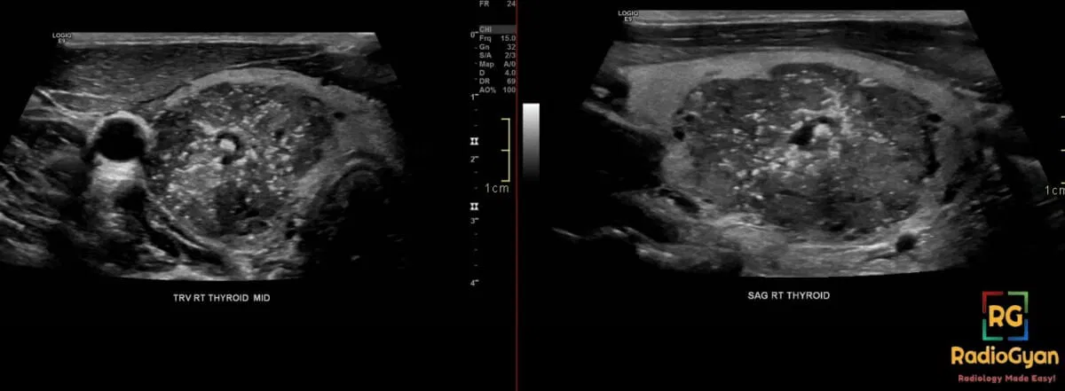Ultrasound image of the right thyroid lobe showing a suspicious nodule with microcalcifications, consistent with papillary thyroid cancer.