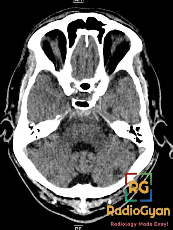 Axial CT brain image demonstrating perimesencephalic subarachnoid hemorrhage.