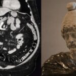 CT abdomen showing a Phrygian cap deformity of the gallbladder next to a statue wearing a Phrygian cap.