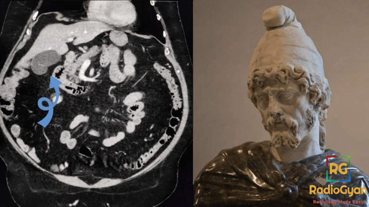 CT abdomen showing a Phrygian cap deformity of the gallbladder next to a statue wearing a Phrygian cap.