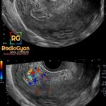 Sagittal grayscale and color Doppler ultrasound of the uterus showing retained products of conception with vascularity.