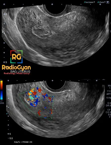 Sagittal grayscale and color Doppler ultrasound of the uterus showing retained products of conception with vascularity.