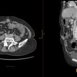 CT axial and sagittal views showing a Sister Mary Joseph Nodule