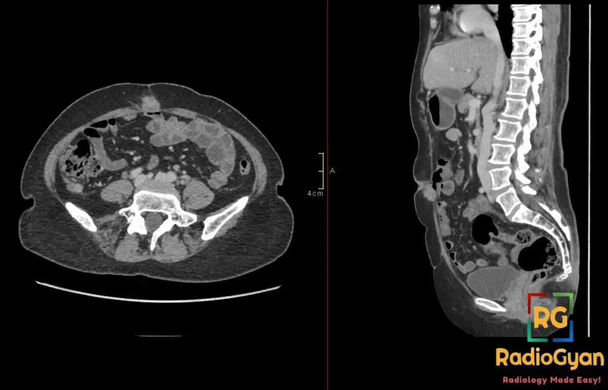 CT axial and sagittal views showing a Sister Mary Joseph Nodule