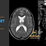 Cerebral and cervical spine MRI showing periventricular white matter lesions and spinal cord findings.