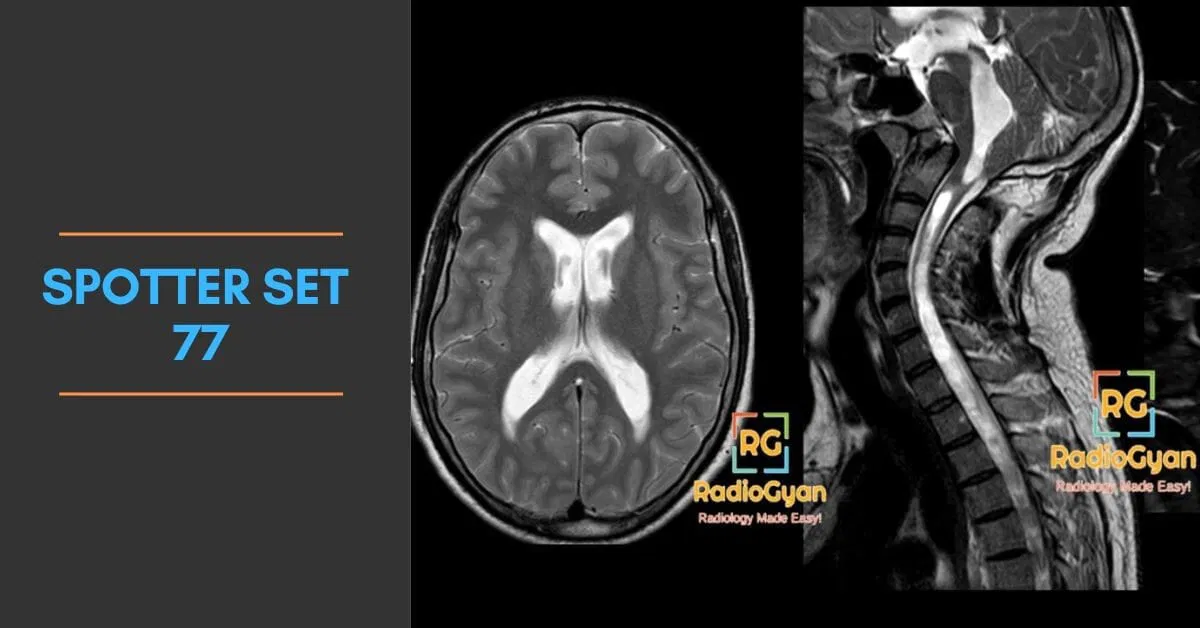 Cerebral and cervical spine MRI showing periventricular white matter lesions and spinal cord findings.