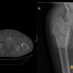CT and X-ray showing tumoral calcinosis of the right hip joint in a CKD patient.