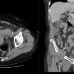 CT axial and coronal views displaying acute sigmoid diverticulitis with intramural abscesses.