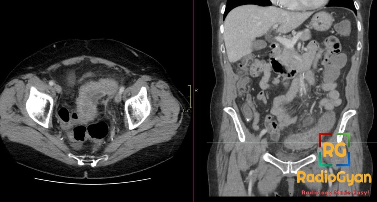 CT axial and coronal views displaying acute sigmoid diverticulitis with intramural abscesses.