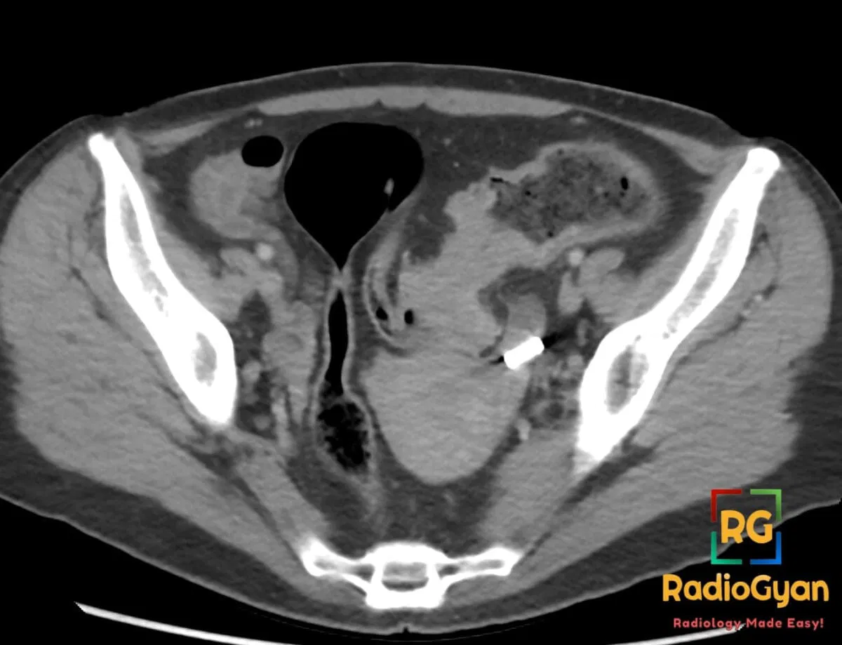Axial CT image showing an 'apple core' lesion in the sigmoid colon, indicative of carcinoma.