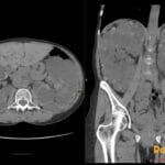 Axial and coronal CT scans showcasing enlarged kidneys and liver with numerous cysts, indicative of Autosomal Dominant Polycystic Kidney Disease (ADPKD).