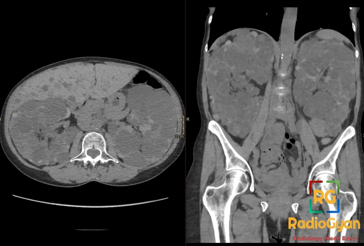 Axial and coronal CT scans showcasing enlarged kidneys and liver with numerous cysts, indicative of Autosomal Dominant Polycystic Kidney Disease (ADPKD).